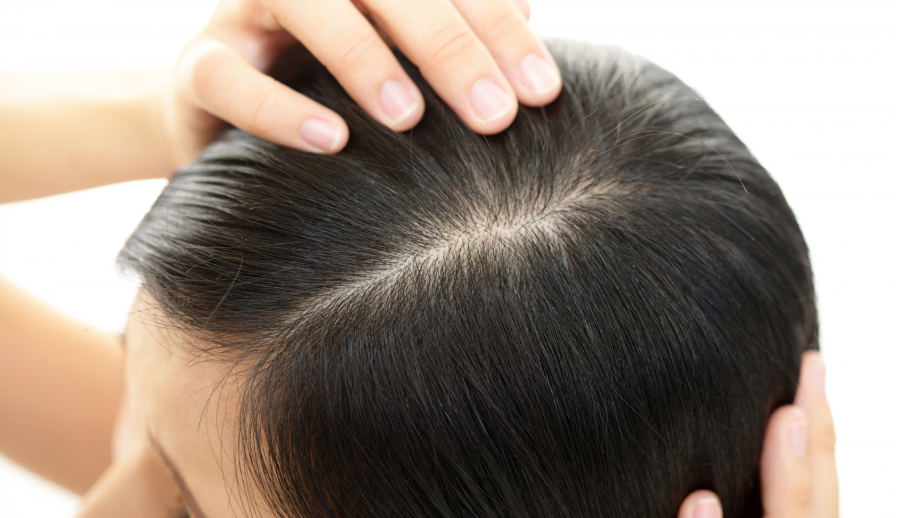 イメージ:薄毛発毛治療